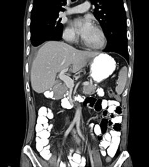 Post-intra-abdominal/intestinal with non-obstructive adhesion, no detectable apparent oral contrast leak, and no pancreatobiliary ductal dilatation.