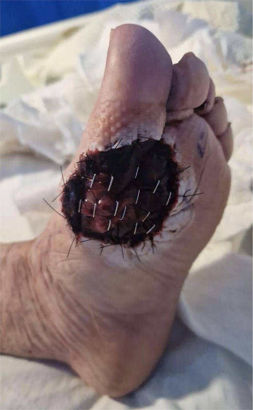 WLE of left ball of foot ALM with BTM in situ 1 week post-operatively.