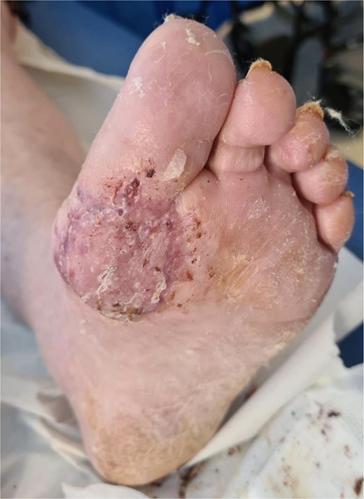 BTM delaminated and SSG inset overtop 1 week post-operatively.