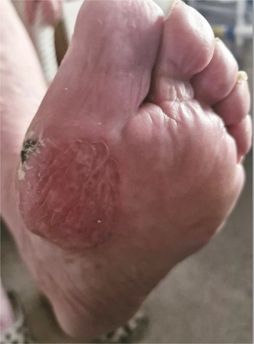 Healed SSG over the left ball of the foot 10 months post-reconstruction.