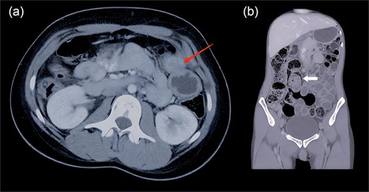 (a and b) Contrast-enhanced computed tomography (axial and coronal view) shows a tubular structure lying next to the colon of size 12.2 × 3.2 cm (arrow 1), running parallel, and sharing its wall (arrow 2). It had fluid inside and did not take contrast.
