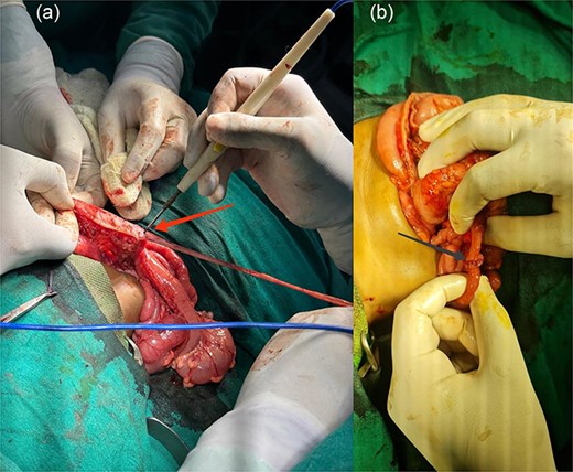 (a and b) Intraoperative complete excision of duplicate colon, ileum, and appendix (arrow 1) and end-to-end ileoileal anastomosis (arrow 2).