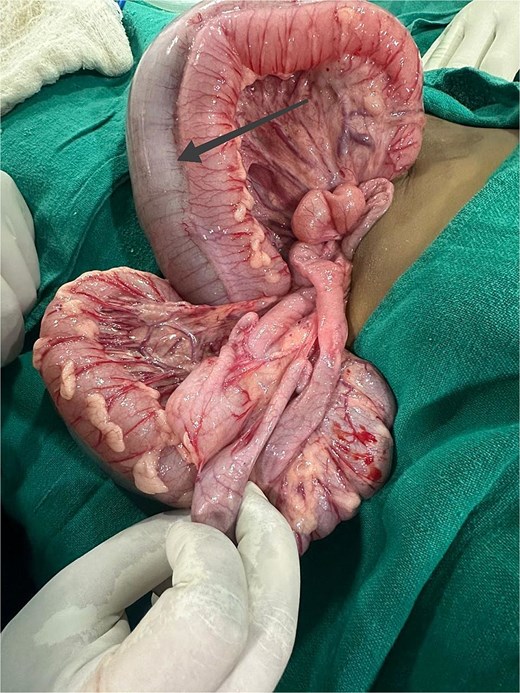 Intraoperative grossly dilated duplicated colon with impacted greenish stool.