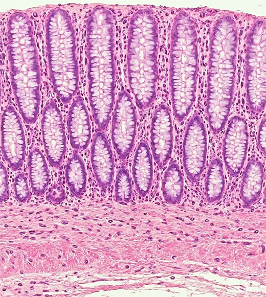 Histopathology of cut section: Colonic mucosa showed tall columnar epithelium with plenty of goblet cells. Crypts were straight and tightly packed and presence of ganglionic cell. Lamina propria had mild inflammation; muscularis mucosae was intact.