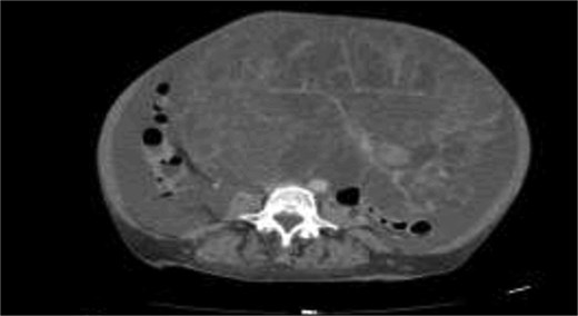 Pre-operative CT scan of the mass.