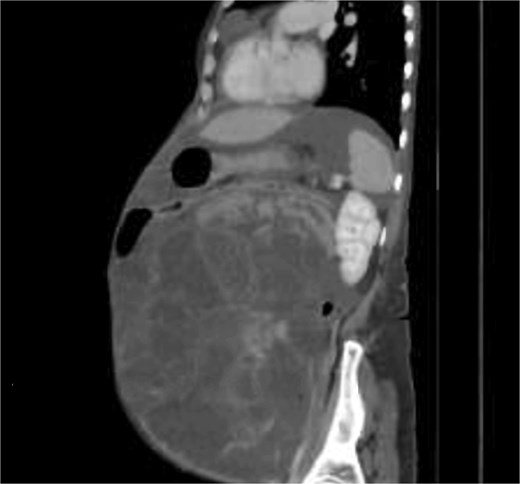 Pre-operative CT scan of the mass.
