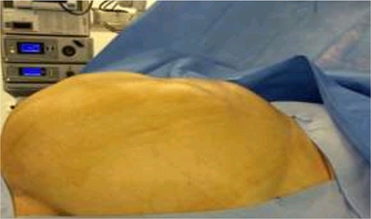 Pre-operative view of the abdomen.