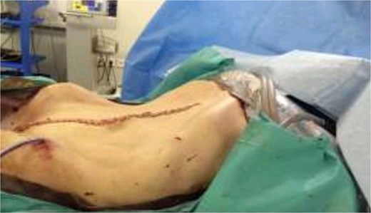Post-operative view of the abdomen.