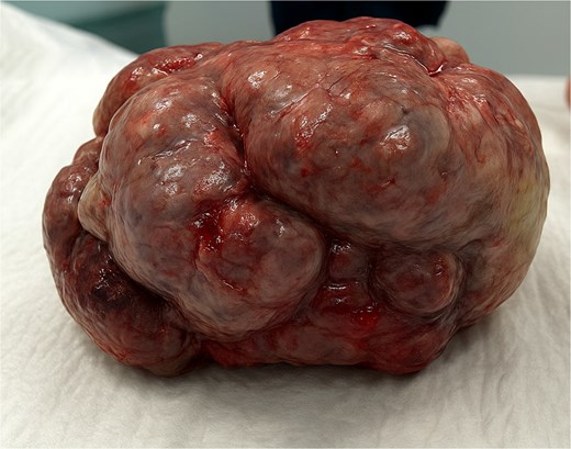 The resected mass.