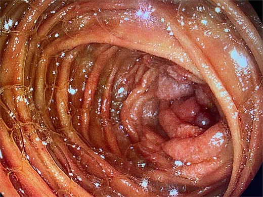 Upper endoscopy showing a proliferative, stenotic lesion in the jejunum.