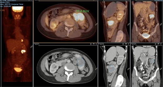 PET/CT showing jejunal wall thickening with increased uptake (SUVmax 17.8).
