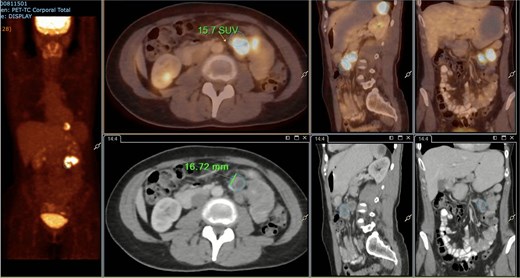 PET/CT showing a hypermetabolic peritumoral lymph node (SUVmax 15.7).