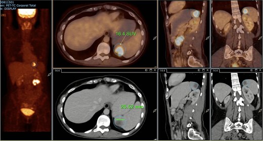 PET/CT showing a hypermetabolic splenic nodule in the upper pole (SUVmax 16.4).