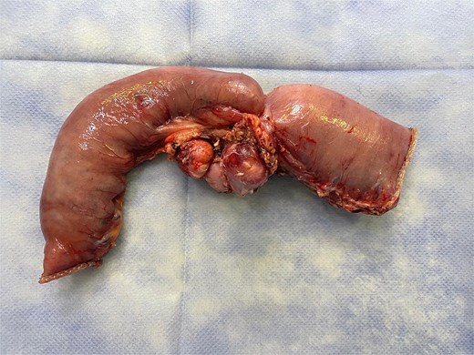 Surgical specimen showing a stenotic jejunal lesion with mesenteric lymph nodes.