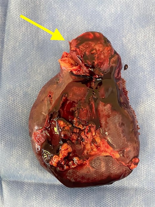 Splenectomy specimen showing the metastatic lesion in the upper pole (arrow).