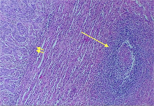 Red and white pulp of the splenic parenchyma (arrow) with infiltration by intestinal-type adenocarcinoma (double arrow, left); H&E ×200.