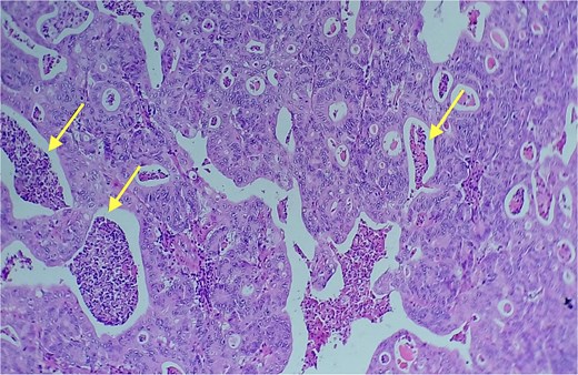 Area of enteric-type adenocarcinoma composed of neoplastic proliferation of columnar epithelial cells with nuclear atypia, eosinophilic cytoplasm, and a complex tubular and cribriform arrangement with endoluminal necrosis (arrows); H&E ×200.