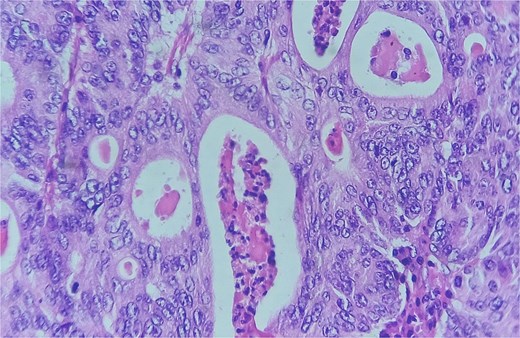 Detail of an area of enteric-type adenocarcinoma composed of neoplastic proliferation of columnar epithelial cells with nuclear atypia, eosinophilic cytoplasm, and a complex tubular and cribriform arrangement with endoluminal necrosis; H&E ×400.