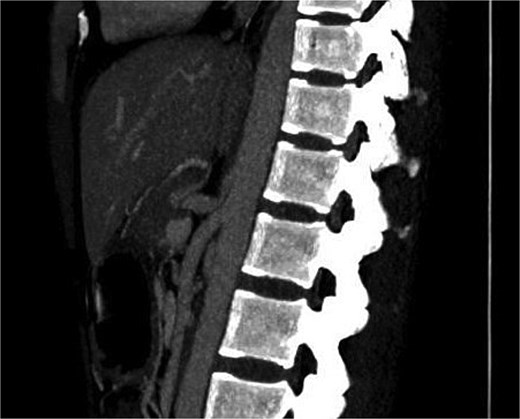 Showing marked focal narrowing at the origin of celiac trunk superior aspect by the arcuate ligament followed by post stenotic dilatation.