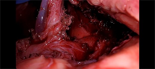 Showing intra-operative thick fibrous bands of median arcuate ligament crossing over the celiac trunk.