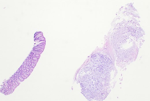 Hematoxylin and eosin–stained section showing colonic mucosa with nests of atypical epithelioid cells within a chondroid matrix, consistent with metastatic chordoma (×10).