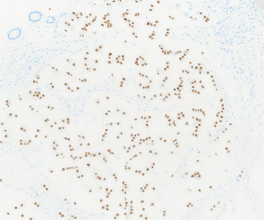 Immunohistochemistry showing strong nuclear positivity for brachyury, confirming the diagnosis of metastatic chordoma (×10).