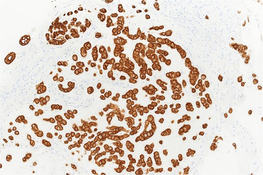 Pancytokeratin immunohistochemistry demonstrating diffuse membranous and cytoplasmic positivity in tumor cells (×40).