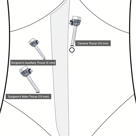 Trocar placement.
