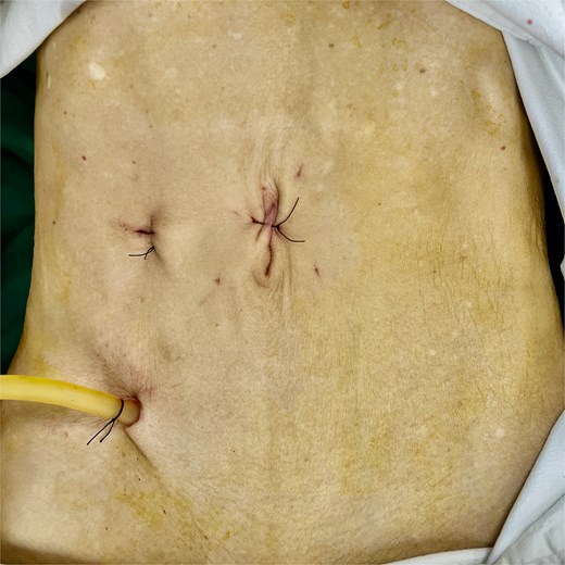 Postoperative abdominal wall.