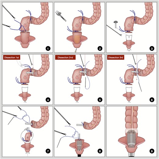 Illustration of three-step dissection with straight needle suturing.