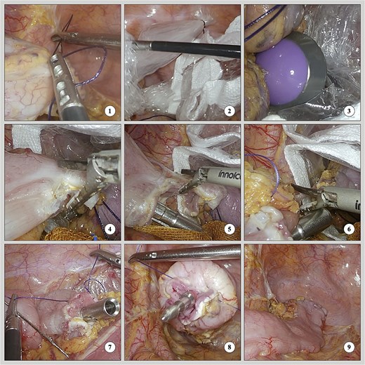 Intraoperative screenshots of three-step dissection with straight needle suturing.