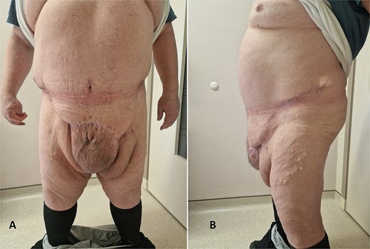 Clinical presentation 5 months after surgery (A—from the front); (B—from the side).