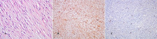 (A) Hematoxylin–eosin stain (×400 HPF); (B) Vimentin positivity (×10 HPF); (C) Ki-67 (×10 HPF).