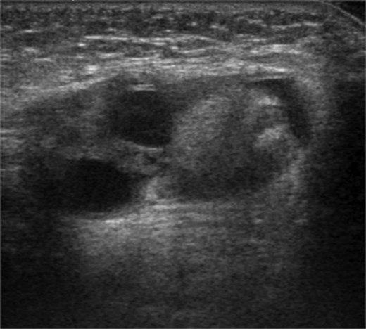 Ultrasonography revealed a 12 mm-sized circular highly echogenic mass and 7- and 8-mm-sized cystic masses within the hernia sac. Ipsilateral ovarian herniation was suspected.
