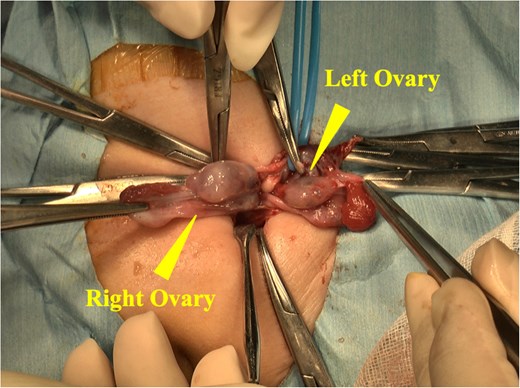 The hernia sac was opened during the procedure, revealing a sliding left ovary and a freely prolapsed right ovary.