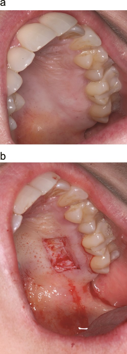 Palatal harvest site (a) palatal wound immediately after graft removal (b).