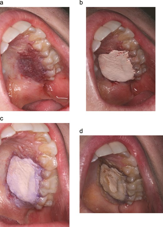 Sandwich dressing technique for palatal donor-site management. (a) First cyanoacrylate (cy) layer extended into interdental embrasures forms a stable margin. (b) Periodontal dressing (PD) adapted with firm digital pressure. (c) Second cy layer seals PD periphery to palatal mucosa creating a low-profile barrier. (d) Palatal appearance on day 14 at the post-operative appointment.