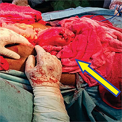 Intra abdominal mop insertion into the pelvis to control bleeding from multiple bleeders after insertion of intra vaginal mop.