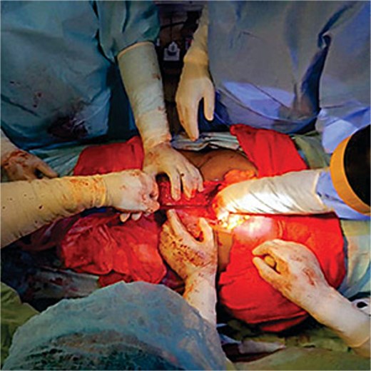 Observation for haemostasis and bleeding was noticed to have stopped.
