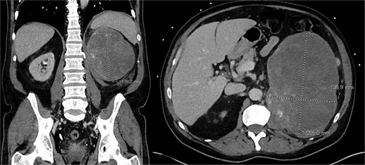 Pre-operative CT scan of abdomen/pelvis findings of a left upper quadrant abdominal mass.