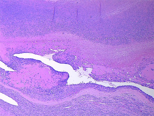 Low power magnification (2×) Hematoxylin and eosin (H&E) showing the angiosarcoma within residual non-neoplastic adrenal cortical tissue. Necrosis is also present.