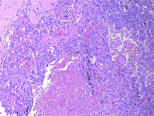 High power magnification (20×) H&E showing malignant cells forming vascular channels with atypia and multiple mitotic figures.
