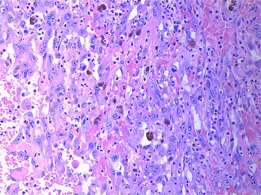High power magnification (40×) H&E showing malignant cells forming vascular channels with atypia.