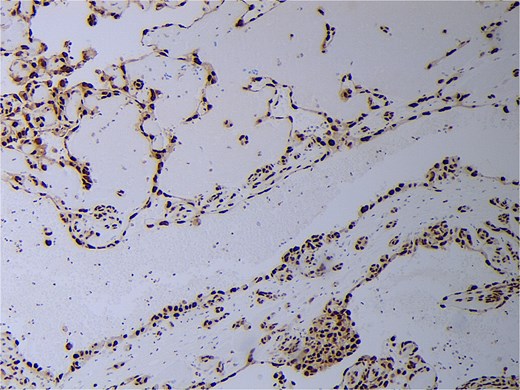 Angiosarcoma staining positive with ERG immunohistochemistry.