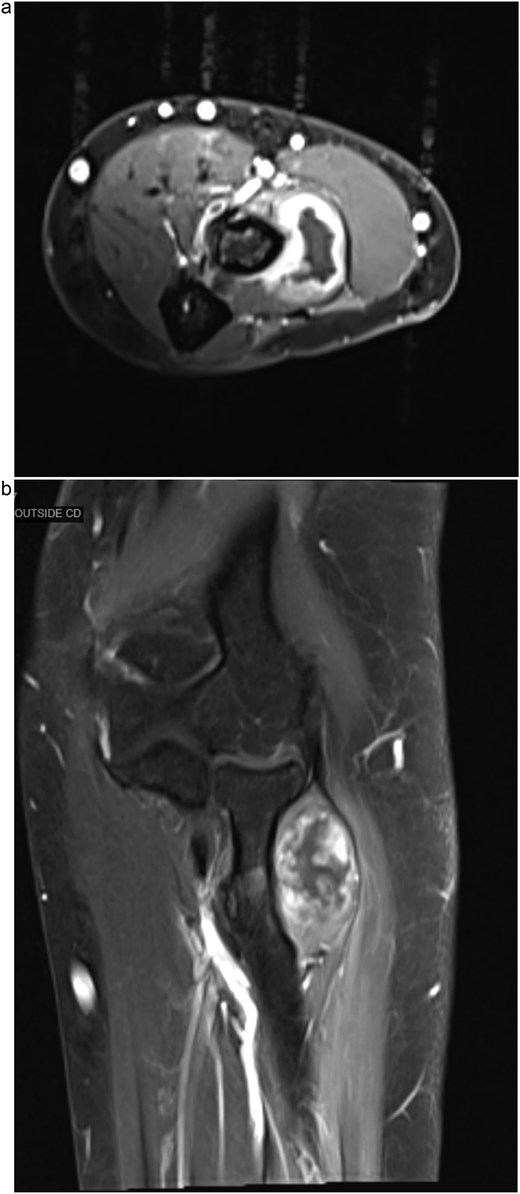 (a) Axial MRI of the forearm demonstrating a mass within the supinator muscle, associated with compression of the PIN. (b) Coronal MRI of the forearm showing a well-defined intramuscular mass within the supinator muscle, with surrounding edema and displacement of adjacent neurovascular structures.