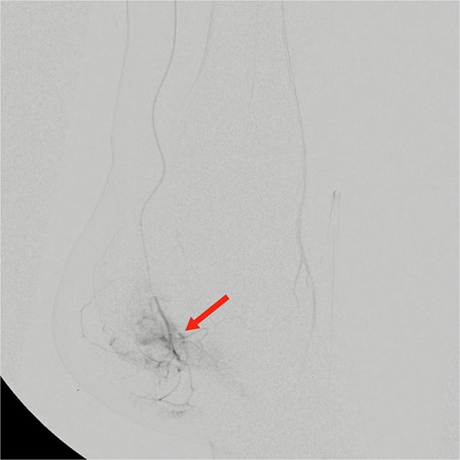 Pre-embolization digital subtraction angiography showing prominent hypervascular blush in branches of the medial plantar artery arising from the distal posterior tibial artery (arrow).