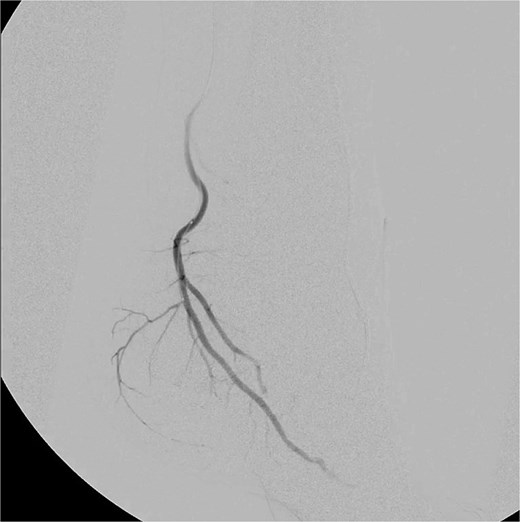Selective catheterization and targeted embolization of the hypervascular branches of the left medial plantar artery using imipenem–Cilastatin (2 mL) as the embolic agent, demonstrating successful occlusion of abnormal vascularity on post-embolization angiography.