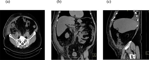 CT scan of the abdomen. Three reconstructions were evaluated: Axial (a), coronal (b), and sagittal (c). The findings suggest a collision of the cecum with the anterior abdominal wall at the site of the previous laparotomy incision, accompanied by surrounding mesenteric stranding. In the region of the anterior abdominal wall, there is fat stranding within the subcutaneous tissue, indicating inflammation, as well as air inclusions originating from the cecum, findings consistent with a colo-cutaneous fistula.