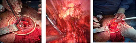 Surgical procedure.