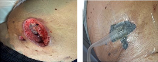 Postoperative wound healing process and NPWT.